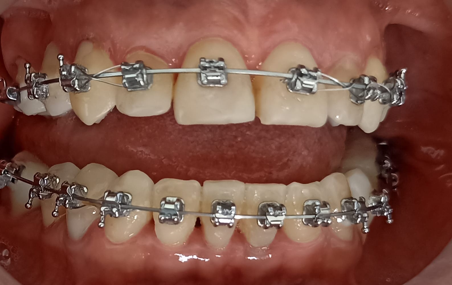 Brackets en Quito: corrige tu sonrisa con un tratamiento seguro y personalizado