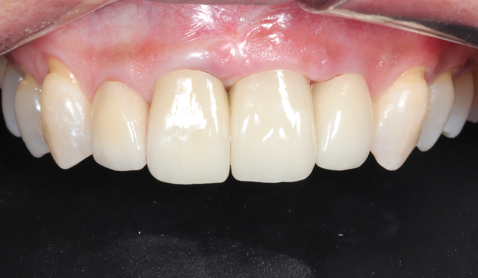 Carillas en resina en Quito: mejora tu sonrisa de forma conservadora y accesible