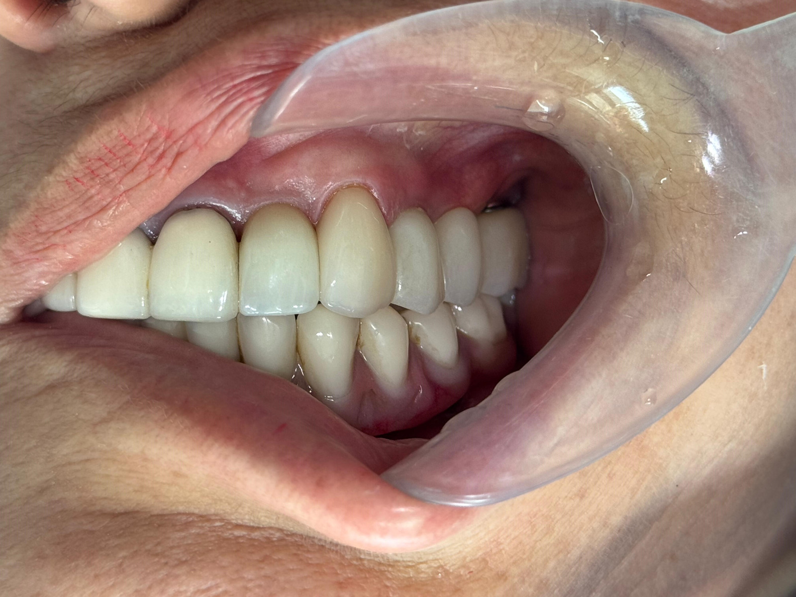 Coronas sobre implantes en Quito: la pieza final para recuperar tu sonrisa