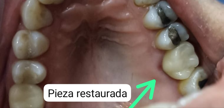 endodoncia en Quito