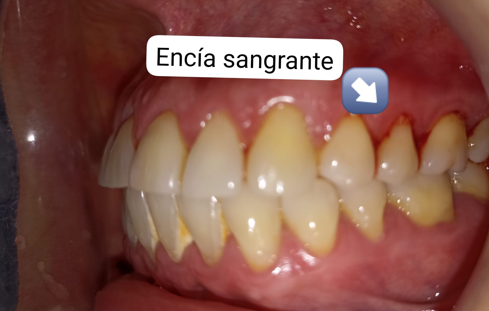 Periodoncia en Quito: tratamiento para encías sanas y evitar la pérdida dental